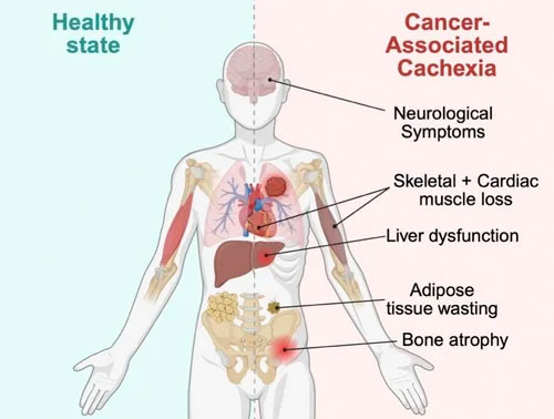 Cachexia