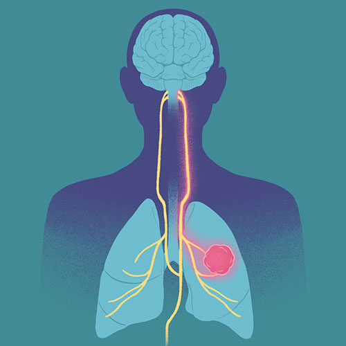 lung cancer